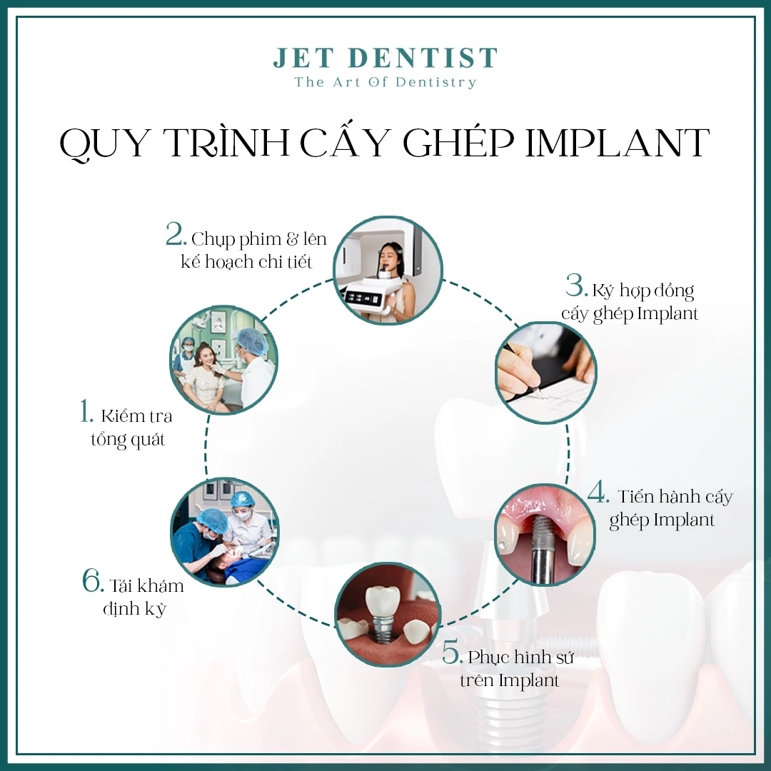 QUY TRÌNH CẤY GHÉP IMPLANT TẠI JET DENTIST