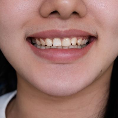 Răng trước khi làm của chị Thùy Linh
