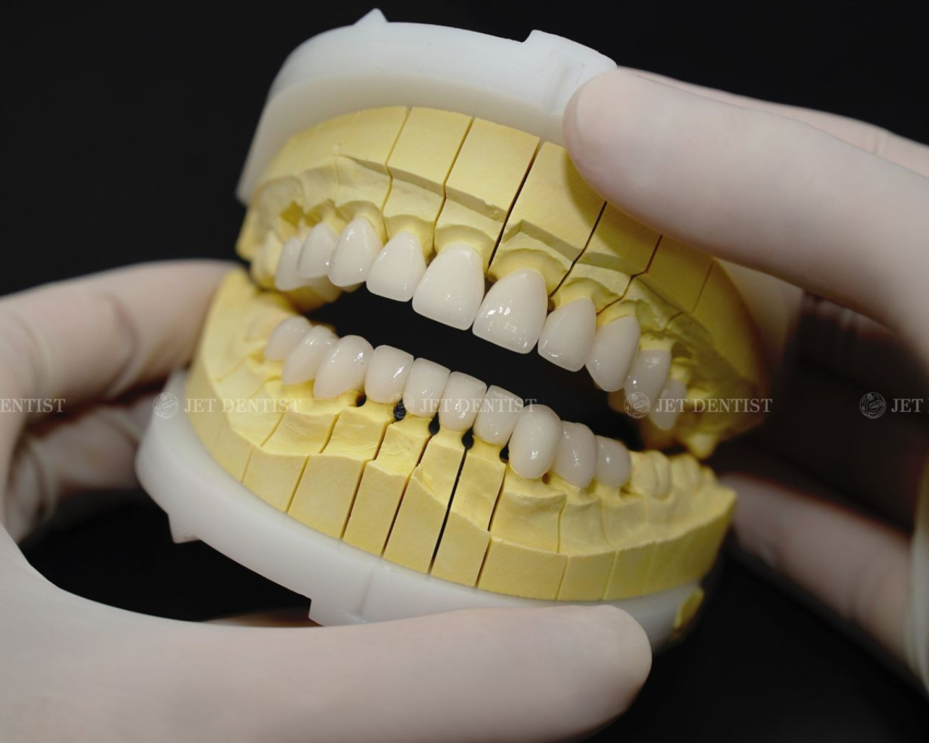 Răng sứ J-Sublime - Lựa chọn hàng đầu của khách hàng tại Jet Dentist