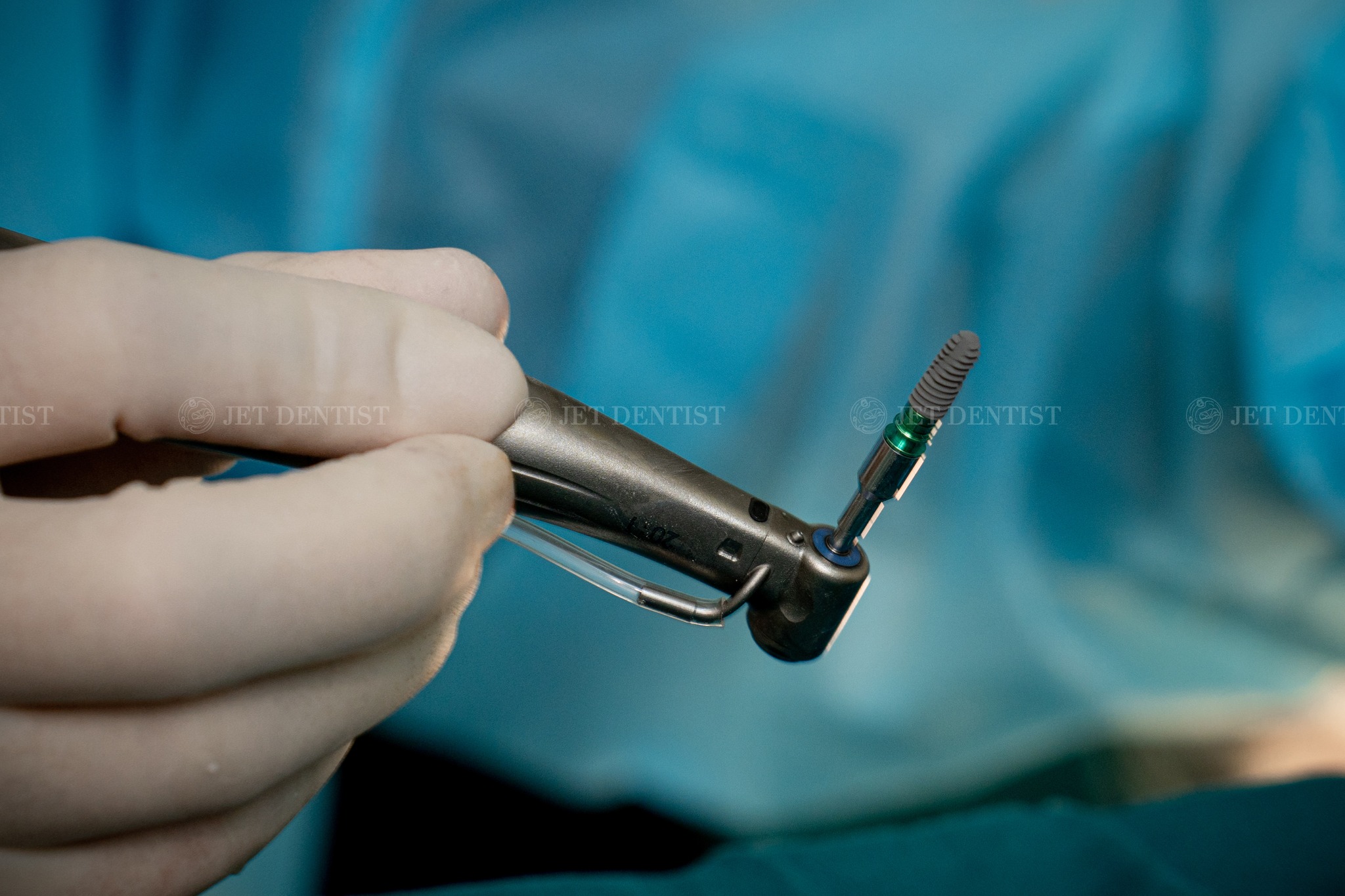 Cấy Implant tức thì là kỹ thuật nhổ răng và cấy Implant tại cùng 1 vị trí trong cùng 1 ca phẫu thuật