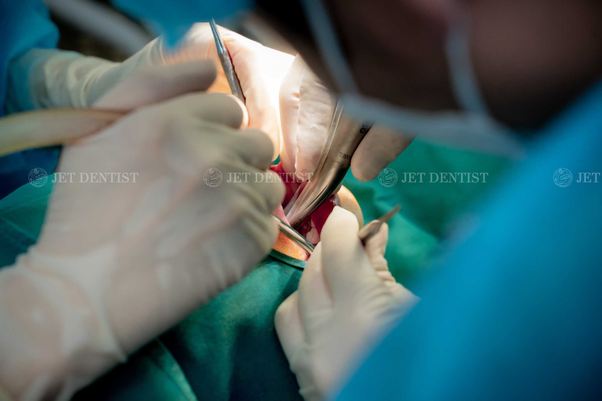 Đối với nhiều trường hợp khách hàng không thể thực hiện được phương pháp Cấy Implant tức thì