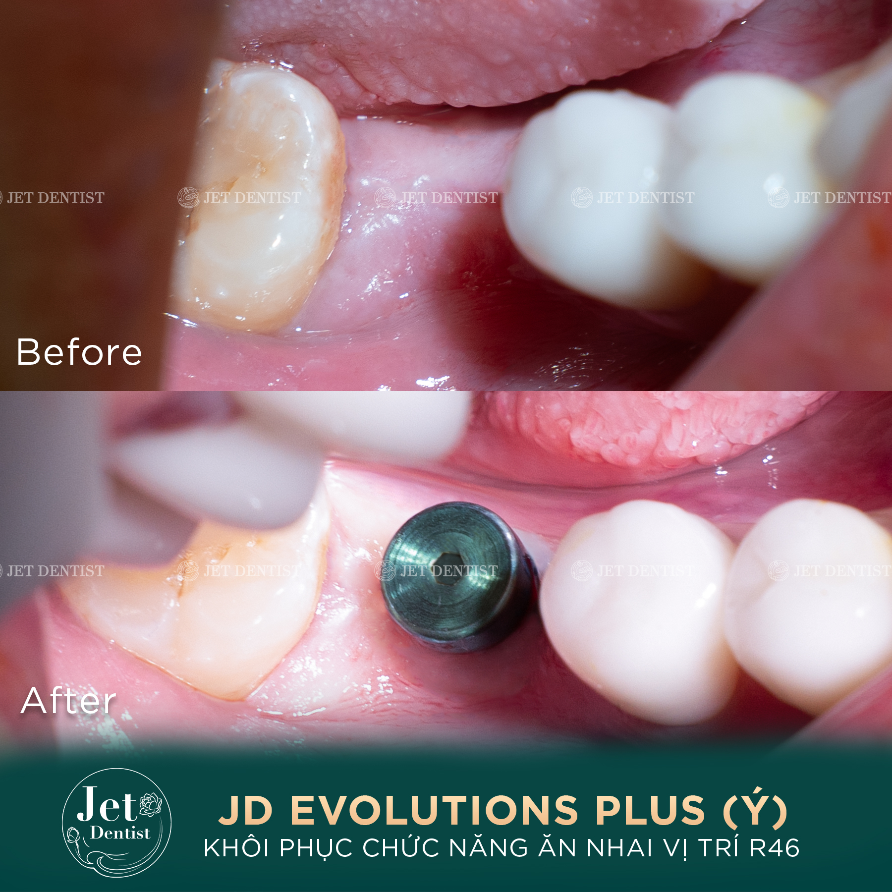 Hình ảnh 1 ca Cấy Implant tức thì tại Jet Dentist