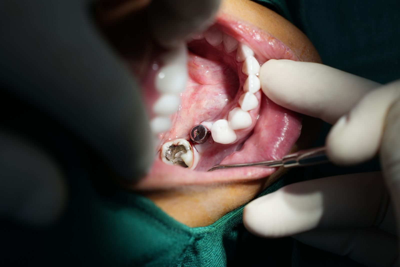 Implant là phương pháp phục hồi hoàn hảo cho tình trạng mất răng