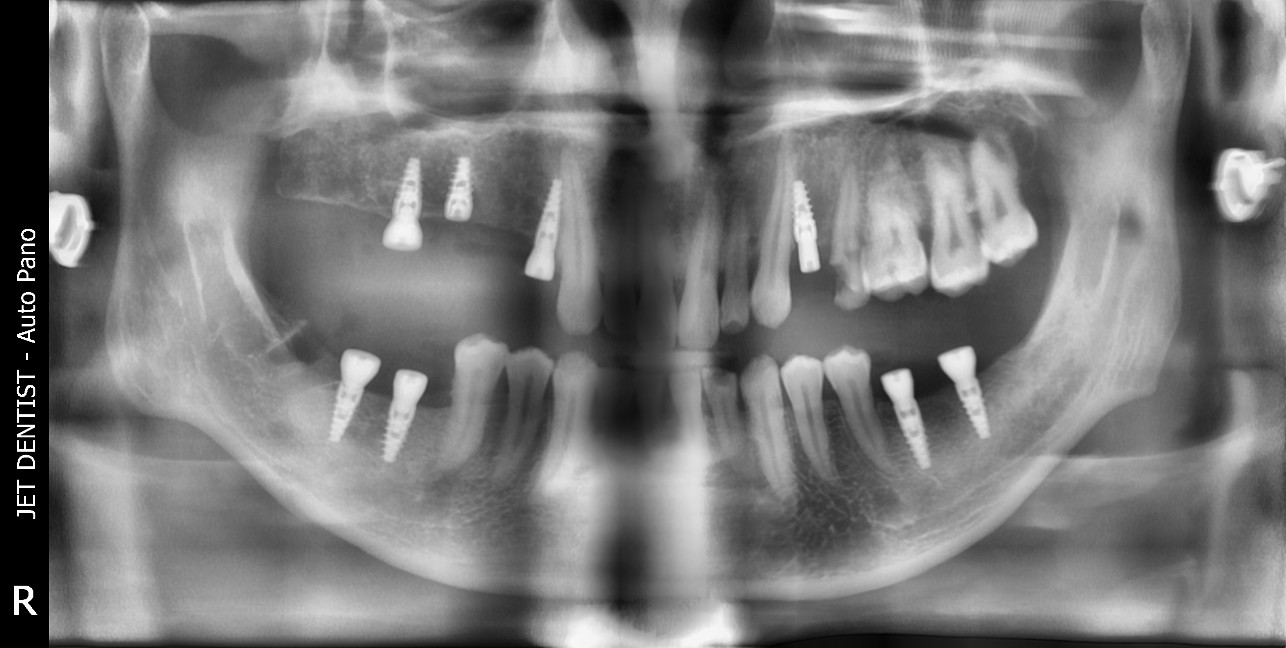 Việc mất đến 8 răng gây ra nhiều bất tiện cho nam khách hàng trong vấn đề sinh hoạt và cả trong giao tiếp