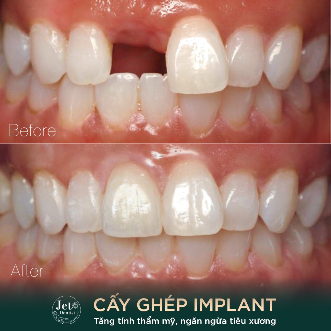 Trồng Implant không chỉ giúp cải thiện tính thẩm mỹ mà còn mang đến nhiều lợi ích cho sức khỏe răng miệng