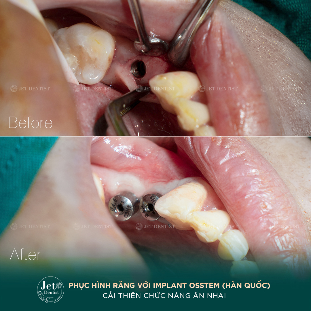 Ca thực tế phục hình Implant Osstem tại Jet Dentist