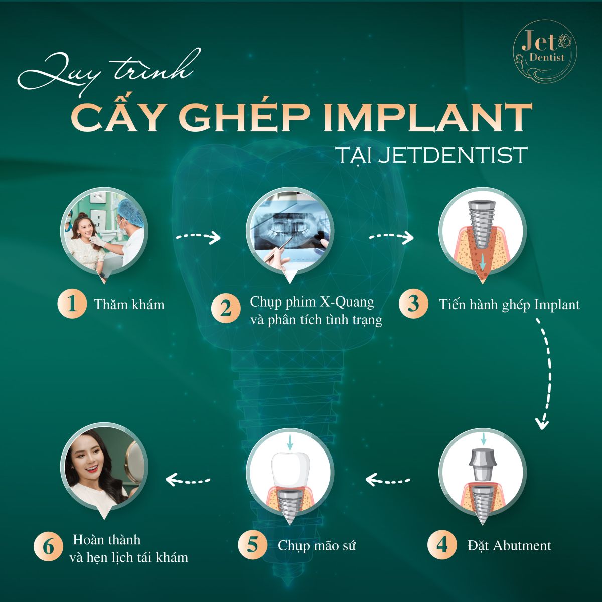 Jet Dentist với quy trình thăm khám, tư vấn và cấy ghép Implant chặt chẽ, cam kết hiệu quả tối ưu