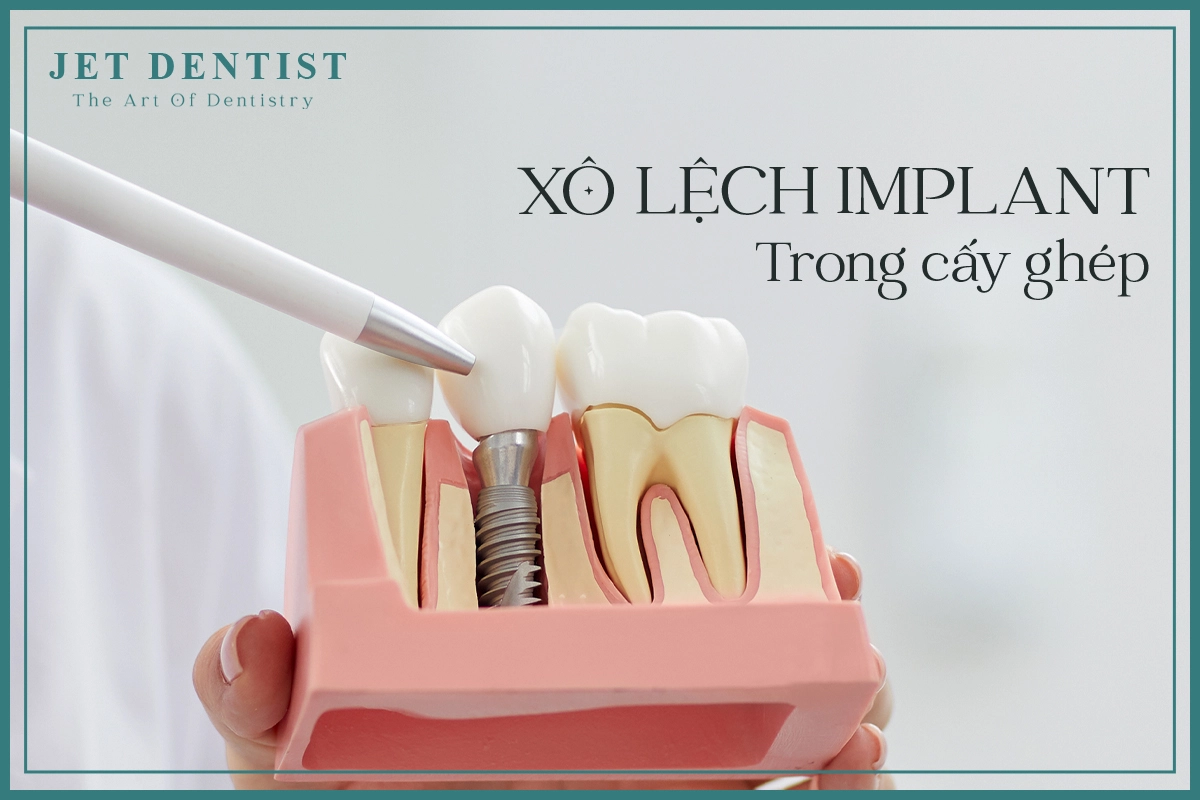 XÔ LỆCH IMPLANT TRONG CẤY GHÉP