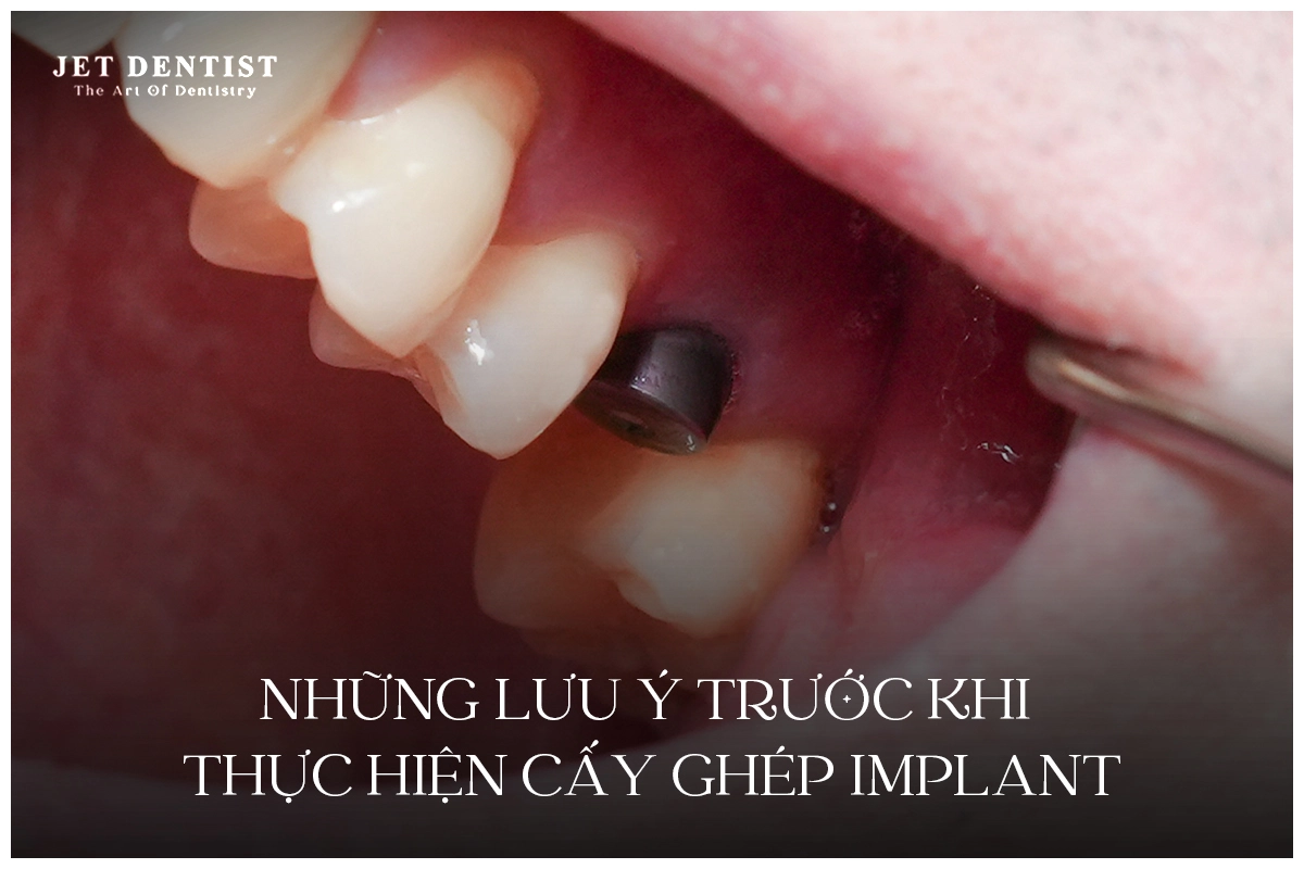 NHỮNG LƯU Ý TRƯỚC KHI THỰC HIỆN CẤY GHÉP IMPLANT