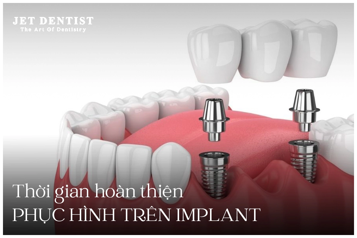 THỜI GIAN CHỜ LÀM PHỤC HÌNH TRÊN IMPLANT MẤT BAO LÂU? 