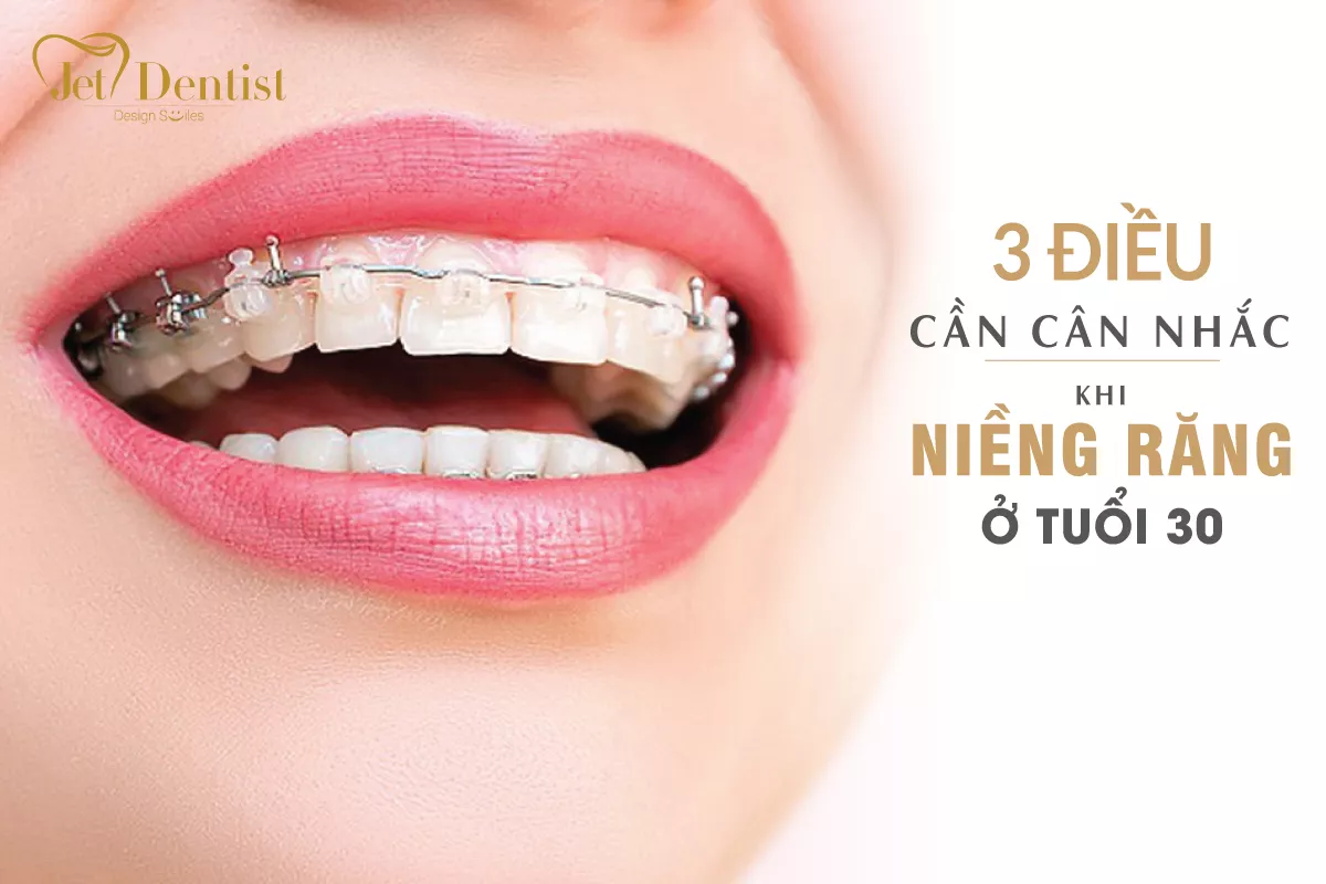 3 điều cần cân nhắc cho việc niềng răng ở tuổi 30