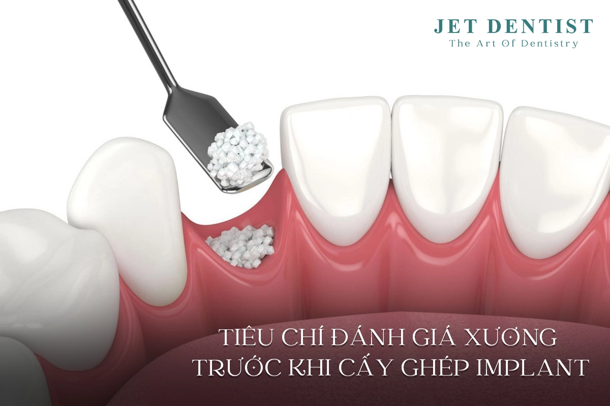 TIÊU CHÍ ĐÁNH GIÁ XƯƠNG TRƯỚC KHI CẤY GHÉP IMPLANT