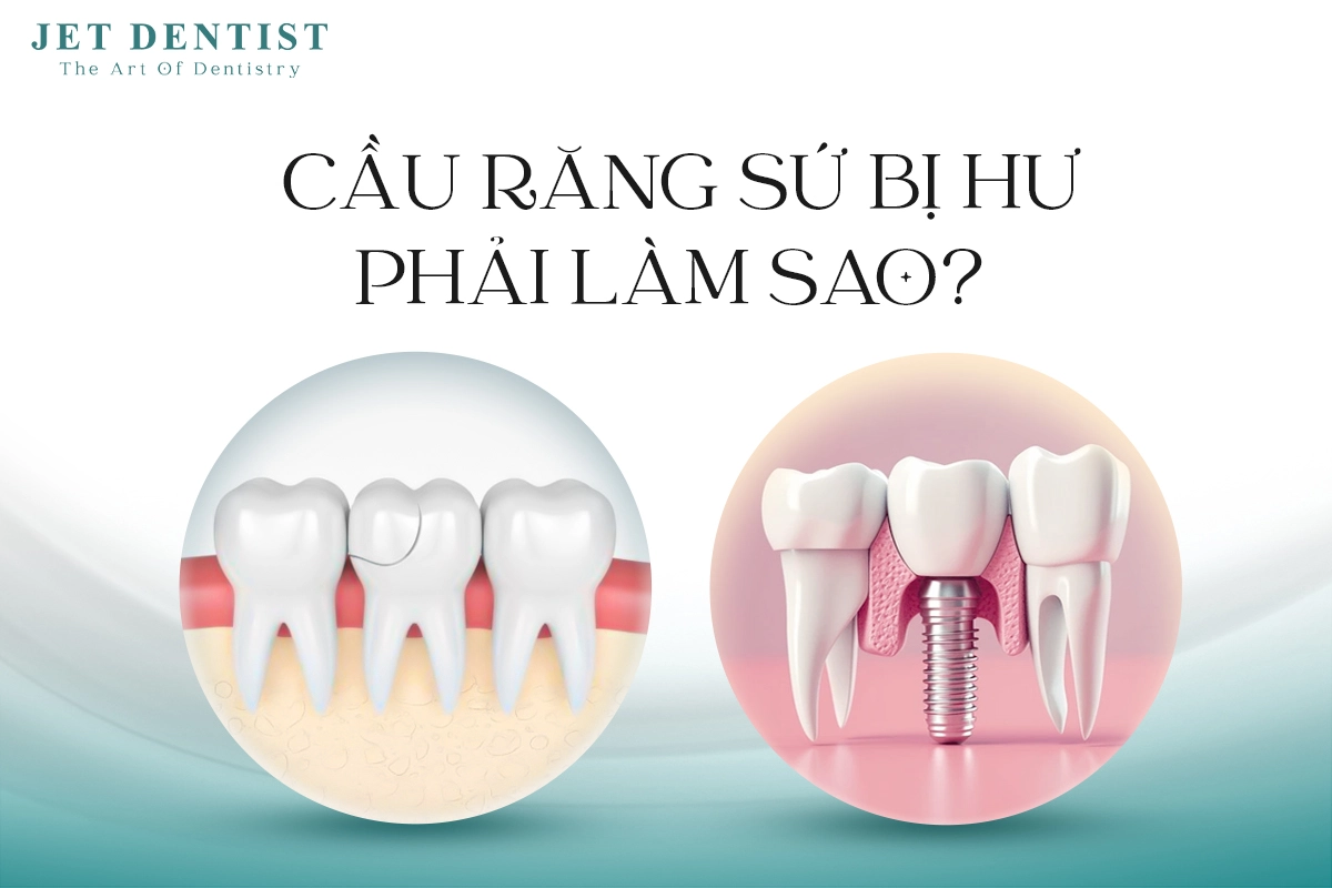 CẦU RĂNG SỨ BỊ HƯ PHẢI LÀM SAO?