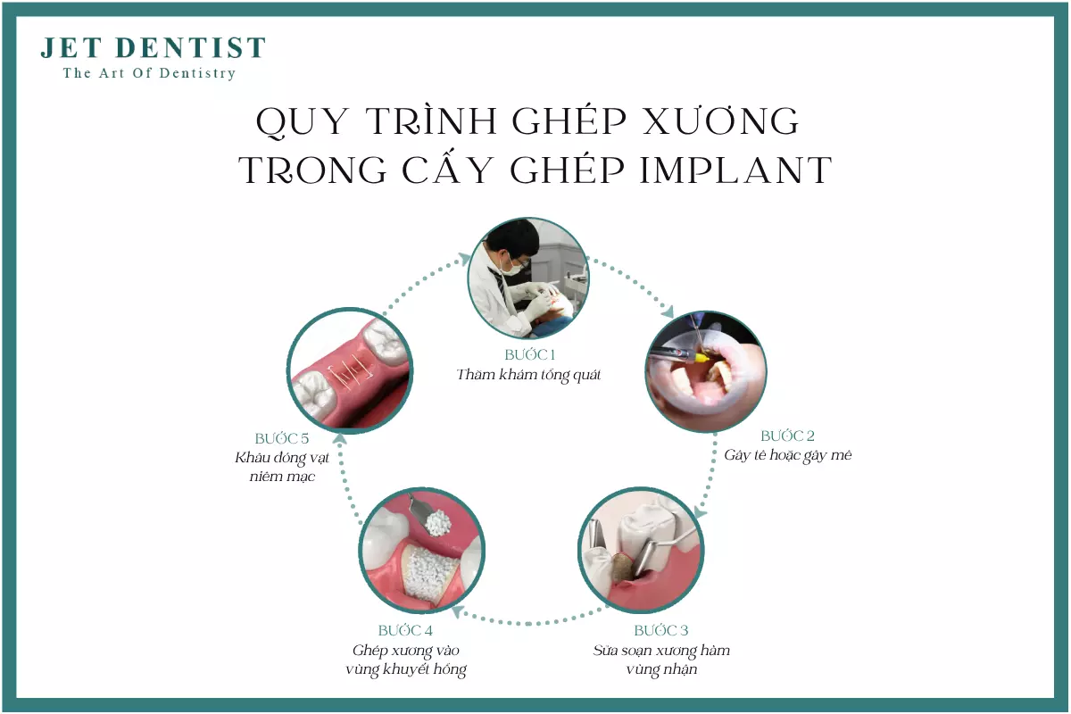 QUY TRÌNH GHÉP XƯƠNG TRONG CẤY GHÉP IMPLANT